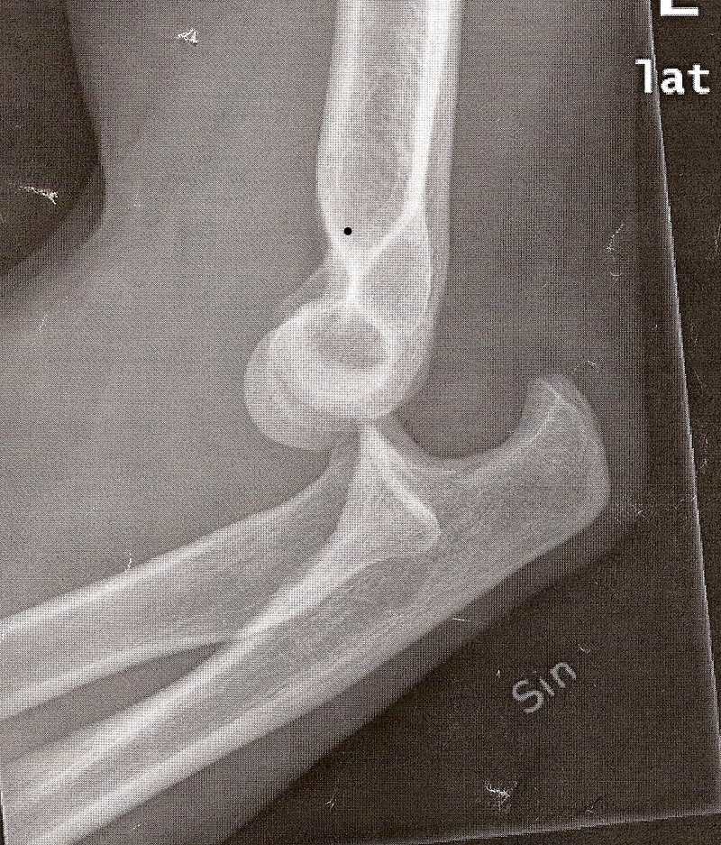 Arm-paj
